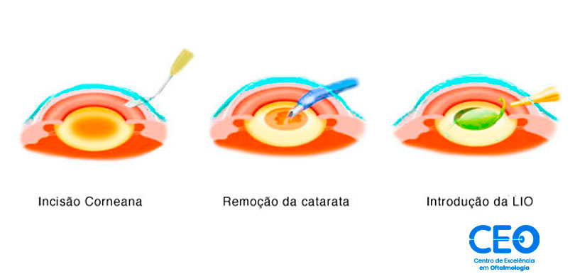 Cirurgia de Catarata Cirurgia de Catarata